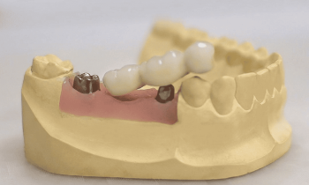 Implantát vs. můstek: co je lepší řešení při ztrátě zubu
